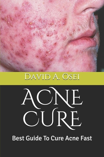 Acne Cure: Best Guide To Cure Acne Fast by Osei, David a.