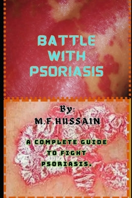 Battle with psoriasis: Complete guide to fight psoriasis by Mir, Feda Hussain