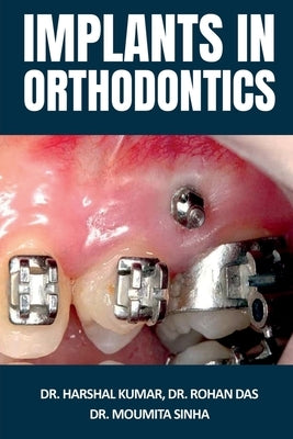 Implants in Orthodontics by Harshal