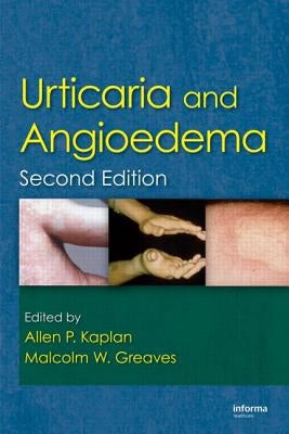 Urticaria and Angioedema by Kaplan, Allen