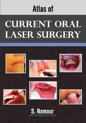 Atlas of Current Oral Laser Surgery by Namour, S.