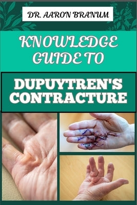 Knowledge Guide to Dupuytren's Contracture: Comprehensive Manual To Symptoms, Treatments, And Preventative Care For Hand Health And Mobility by Branum, Aaron