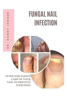 Fungal Nail Infection: Guide for Taking Care of Your Nail to Prevent Infection by Jensen, Danny