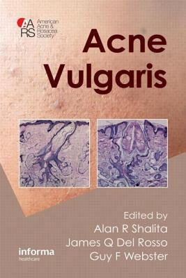 Acne Vulgaris by Shalita, Alan R.