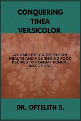 Conquering Tinea Versicolor: A Complete Guide to Skin Health and Nourishing Food Recipes to Combat Fungal Infections by S, Oftelith