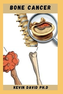 Bone Cancer: Easy To Prepare Calcium Rich Recipes To Heal Bone Cancer Includes How To Get Started by David Ph. D., Kevin