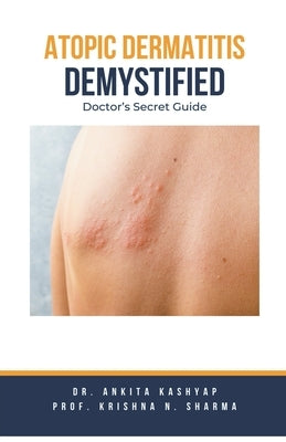 Atopic Dermatitis Demystified: Doctor's Secret Guide by Kashyap, Ankita