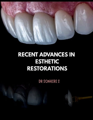 Recent Advances in Esthetic Restorations: Recent advances in direct and indirect restorations by Dr Sona Sri S