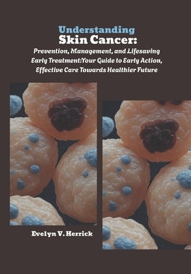 Understanding Skin Cancer: Prevention, Management, and Lifesaving Early Treatment: Your Guide to Early Action, Effective Care Towards Healthier Future by V. Herrick, Evelyn