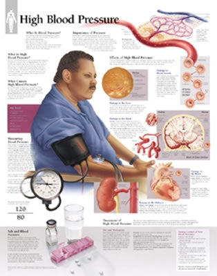 High Blood Pressure Chart: Laminated Wall Chart by Scientific Publishing