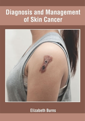 Diagnosis and Management of Skin Cancer by Burns, Elizabeth