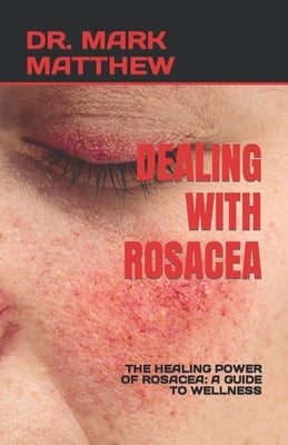 Dealing with Rosacea: The Healing Power of Rosacea: A Guide to Wellness by Matthew, Mark