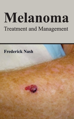 Melanoma: Treatment and Management by Nash, Frederick
