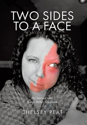 Two Sides to a Face: My Journey with Sturge Weber Syndrome by Peat, Chelsey