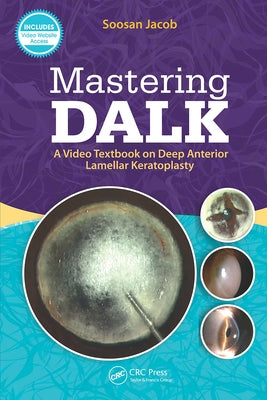 Mastering DALK: A Video Textbook on Deep Anterior Lamellar Keratoplasty by Jacob, Soosan