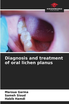 Diagnosis and treatment of oral lichen planus by Garma, Maroua