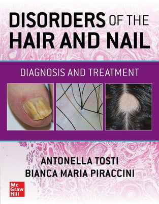Disorders of the Hair and Nail: Diagnosis and Treatment by Tosti, Antonella