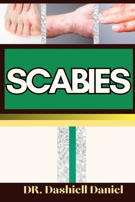 Scabies: Expert Guide To Understanding Scabies Causes, Symptoms, Preventing, Treatment for optimal wellness by Daniel, Dashiell