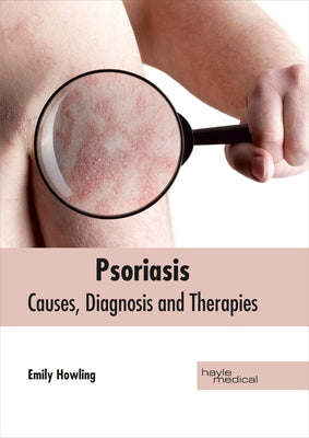 Psoriasis: Causes, Diagnosis and Therapies by Howling, Emily