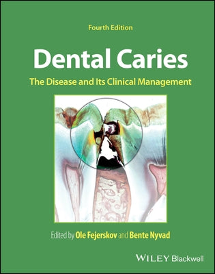 Dental Caries: The Disease and Its Clinical Management by Fejerskov, Ole