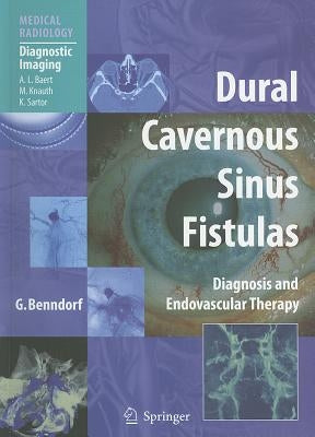 Dural Cavernous Sinus Fistulas: Diagnosis and Endovascular Therapy by Benndorf, Goetz