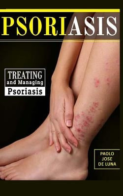 Psoriasis: Treating and Managing Psoriasis by Jose De Luna, Paolo