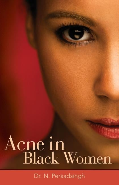 Acne in Black Women by Persadsingh, N.