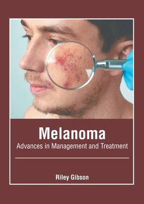 Melanoma: Advances in Management and Treatment by Gibson, Riley