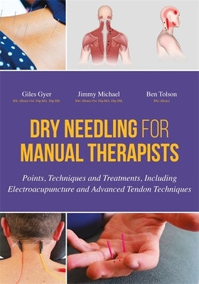 Dry Needling for Manual Therapists: Points, Techniques and Treatments, Including Electroacupuncture and Advanced Tendon Techniques by Gyer, Giles