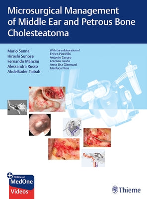 Microsurgical Management of Middle Ear and Petrous Bone Cholesteatoma by Sanna, Mario