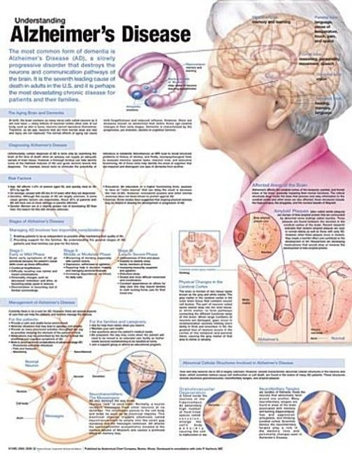 Understanding Alzheimer's Disease Anatomical Chart by Anatomical Chart Company