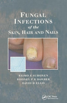 Fungal Infections of the Skin and Nails by Suhonen, Raimo E.