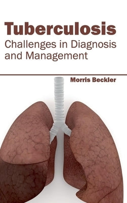 Tuberculosis: Challenges in Diagnosis and Management by Beckler, Morris