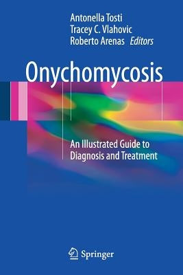 Onychomycosis: An Illustrated Guide to Diagnosis and Treatment by Tosti, Antonella