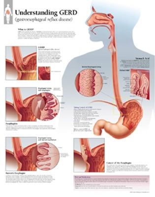 Understanding Gerd Chart: Wall Chart by Scientific Publishing