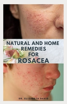 Natural and Home Remedies for Rosacea: A Self Help Guide To Completely Prevent and Treat Rosacea by David, Elizabeth