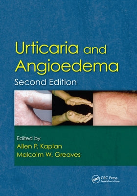 Urticaria and Angioedema by Kaplan, Allen