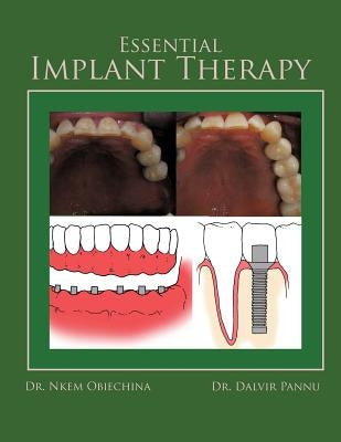 Essential Implant Therapy: A Patient's Guide to Understanding Implant Dentistry by Obiechina, Nkem
