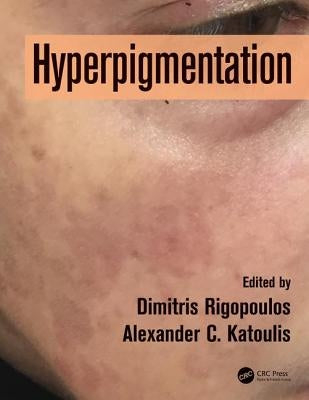 Hyperpigmentation by Rigopoulos, Dimitris