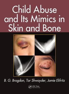 Child Abuse and its Mimics in Skin and Bone by Brogdon, B. G.