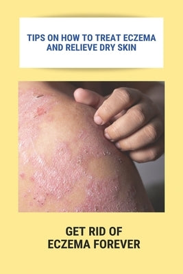 Tips On How To Treat Eczema And Relieve Dry Skin: Get Rid Of Eczema Forever: Overcome Eczema by Apkin, Courtney