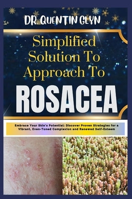 Simplified Solution Approach To ROSACEA: Embrace Your Skin's Potential: Discover Proven Strategies for a Vibrant, Even-Toned Complexion and Renewed Se by Glyn, Quentin