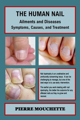 THE HUMAN NAIL - Ailments and Diseases: Symptoms, Causes, and Treatment by Mouchette, Pierre