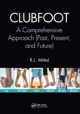 Clubfoot: A Comprehensive Approach (Past, Present, and Future) by Mittal, R. L.