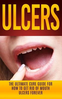 Ulcers: The Ultimate Cure Guide for How to Get Rid of Mouth Ulcers Instantly by Migan, Wade