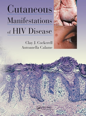 Cutaneous Manifestations of HIV Disease by Cockerell, Clay