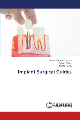Implant Surgical Guides by D'Souza, Ancita Caroline