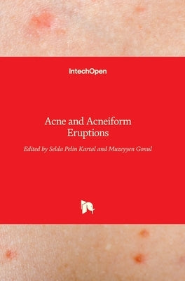 Acne and Acneiform Eruptions by Kartal, Selda Pelin