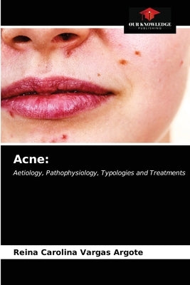 Acne by Vargas Argote, Reina Carolina