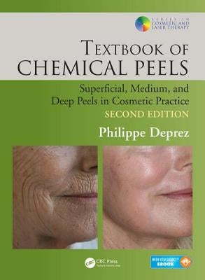 Textbook of Chemical Peels: Superficial, Medium, and Deep Peels in Cosmetic Practice by Deprez, Philippe
